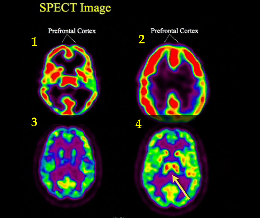 Simulación de un ‘SPECT‘ del cerebro de Becks en las cuatro fases de su agonía: 1- Escaner en estado normal. Flujo distribuido. 2- Lóbulos frontales con mayor flujo. Se pone atención en los músculos. Apenas hay actividad en el centro o de ‘recuerdos’. 3- Flujo desaparece. Casi no hay actividad. 4- La parte central o de recuerdos se ilumina de nuevo, al pensar en su familia.